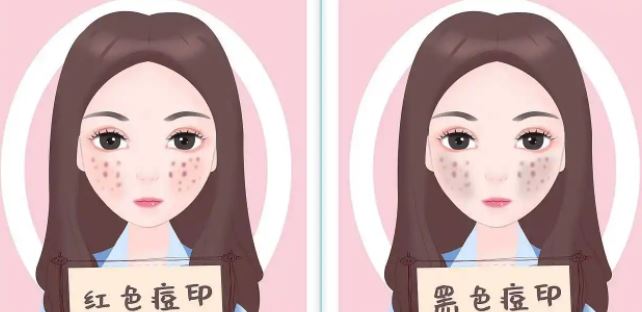 臉上紅色痘印幾個月都不消怎么辦？紅色痘印應(yīng)該怎么消除？