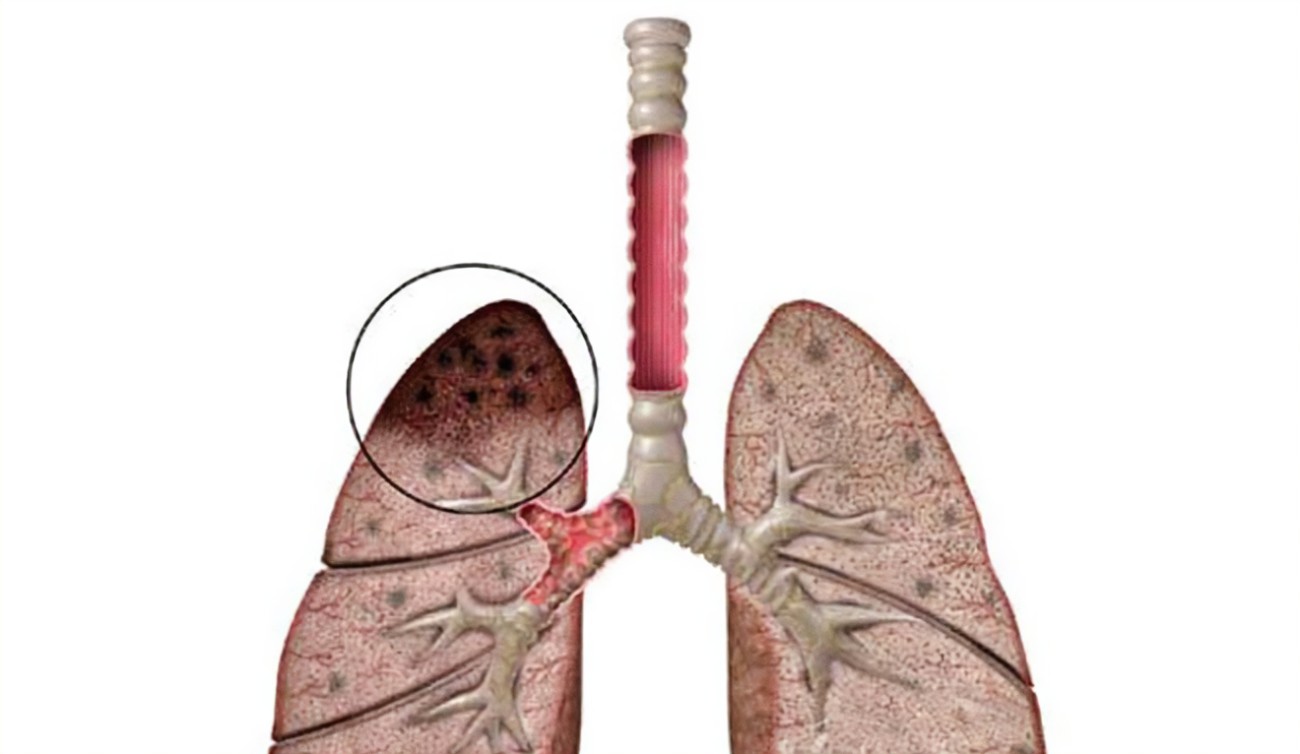 肺結核篩查做什么檢查？