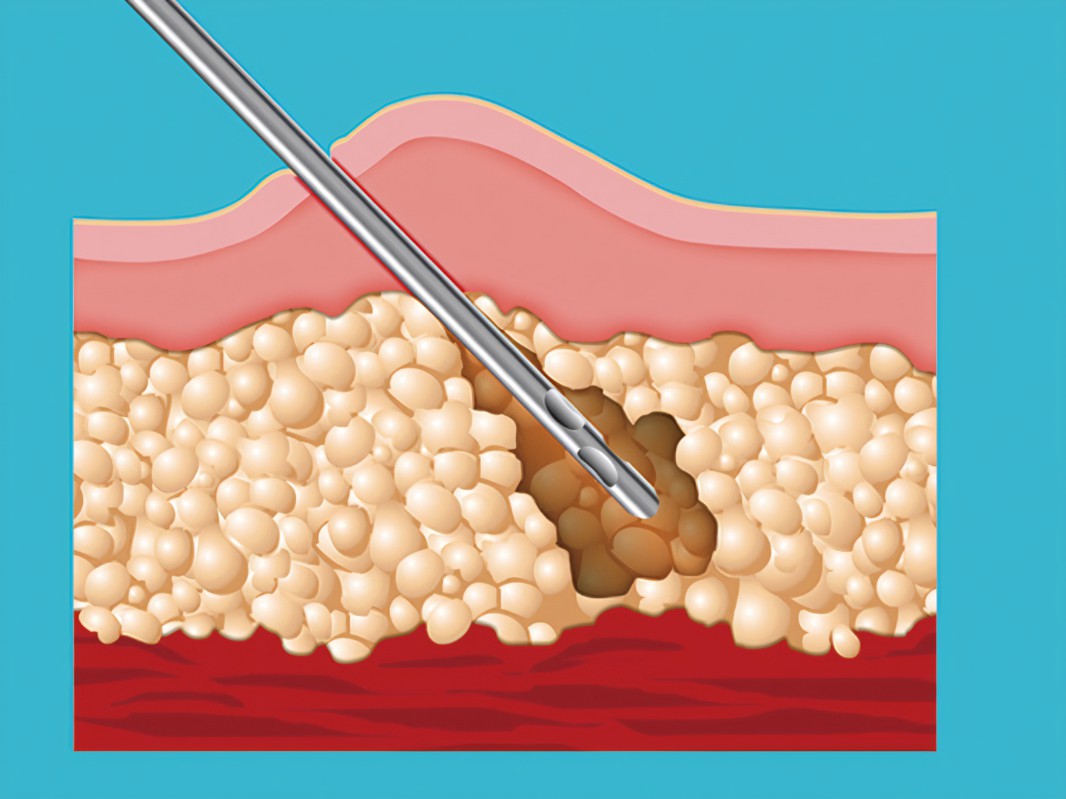 胸太大可以抽脂嗎多少錢？